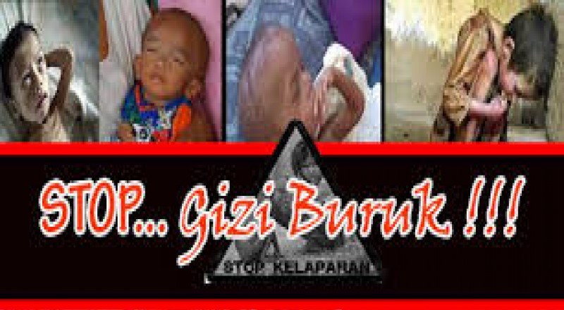 ilustrasi gizi buruk